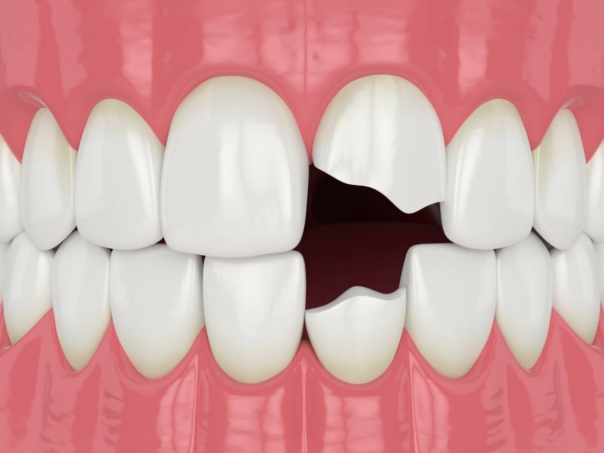 Featured image for How to Fix a Chipped Tooth
