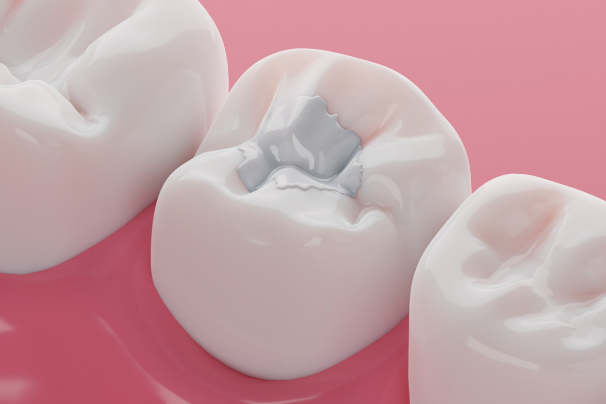 Featured image for How Long Do Composite Fillings Last?